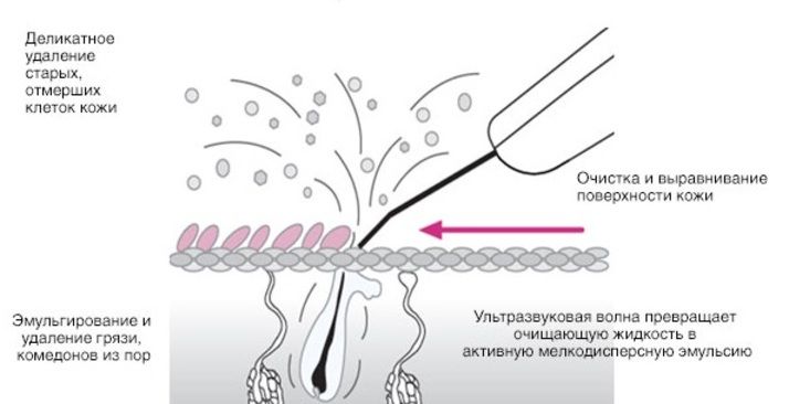 Ультразвуковой аппарат–скрабер Skin Cleaner LW-006 (YH-H01)