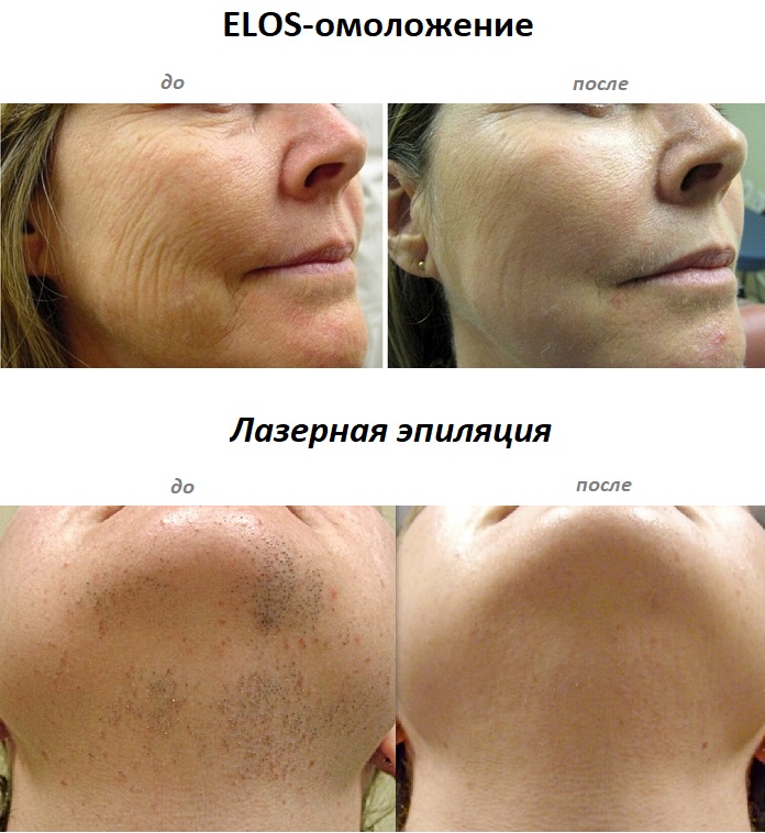 elos-omologenie-do-i-posle5.jpg elos-omologenie-do-i-posle5.jpg