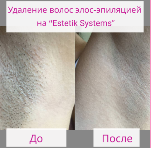 Аппарат Estetik Systems 4 в 1: SHR, Элос, Yag-лазер, РФ-лифтинг