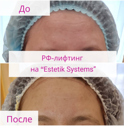 Аппарат Estetik Systems 4 в 1: SHR, Элос, Yag-лазер, РФ-лифтинг