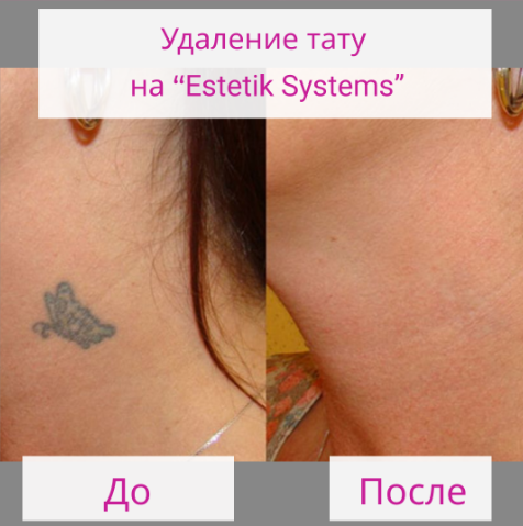Аппарат Estetik Systems 4 в 1: SHR, Элос, Yag-лазер, РФ-лифтинг